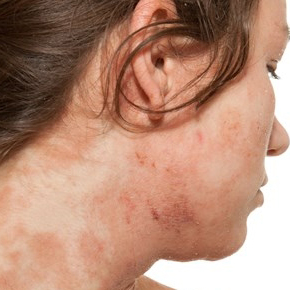 ОСТОРОЖНО! ЛЯМБЛИОЗ!