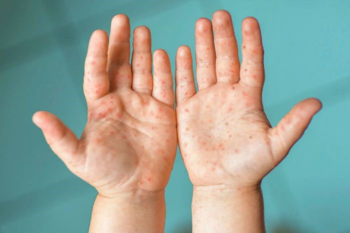 Профилактика энтеровирусной инфекции (ЭВИ)