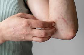 ОСТОРОЖНО! ЧЕСОТКА!