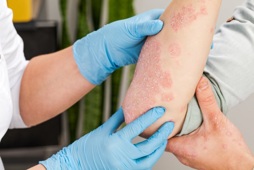 Летние болезни:  когда «расцветают» кожные инфекции